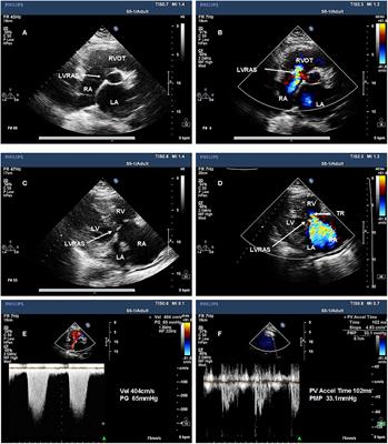 Higher Incidence of Atrial Fibrillation in Left Ventricular-to-Right Atrial Shunt Patients